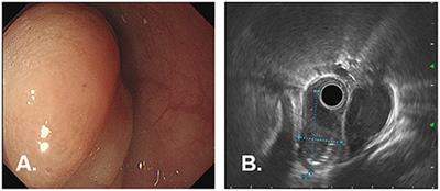 En Bloc Resection of Primary Large Esophageal Mucosa-Associated Lymphoid Tissue Lymphoma by Endoscopic Submucosal Dissection: A Case Report
